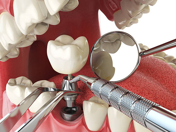 Best Emergency Treatment for Dental Infections or Abscesses in Advance, MO